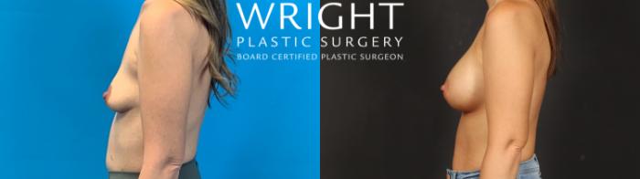 Before & After Breast Augmentation Case 637 Left Side View in Little Rock, Arkansas