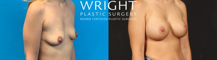 Before & After Breast Augmentation Case 637 Right Oblique View in Little Rock, Arkansas