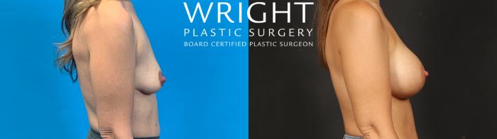 Before & After Breast Augmentation Case 637 Right Side View in Little Rock, Arkansas