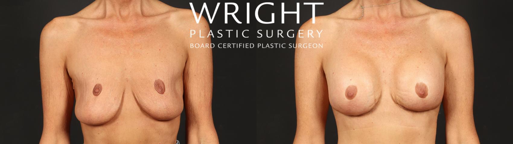 Before & After Breast Augmentation Case 638 Front View in Little Rock, Arkansas