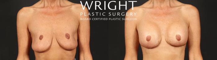 Before & After Breast Augmentation Case 638 Front View in Little Rock, Arkansas