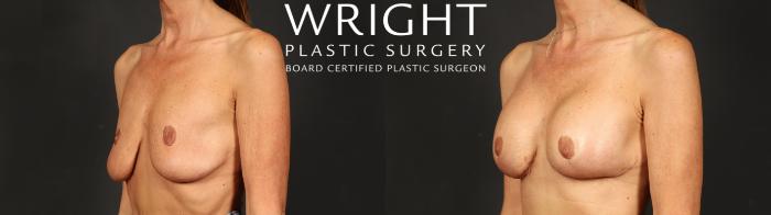 Before & After Breast Augmentation Case 638 Left Oblique View in Little Rock, Arkansas