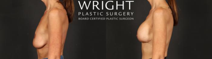 Before & After Breast Augmentation Case 638 Left Side View in Little Rock, Arkansas