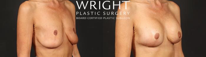 Before & After Breast Augmentation Case 638 Right Oblique View in Little Rock, Arkansas