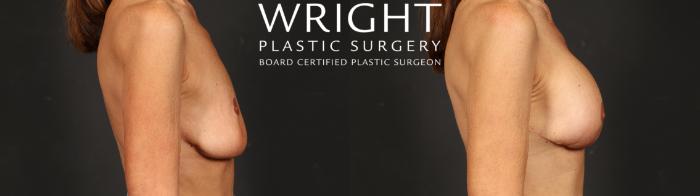 Before & After Breast Augmentation Case 638 Right Side View in Little Rock, Arkansas