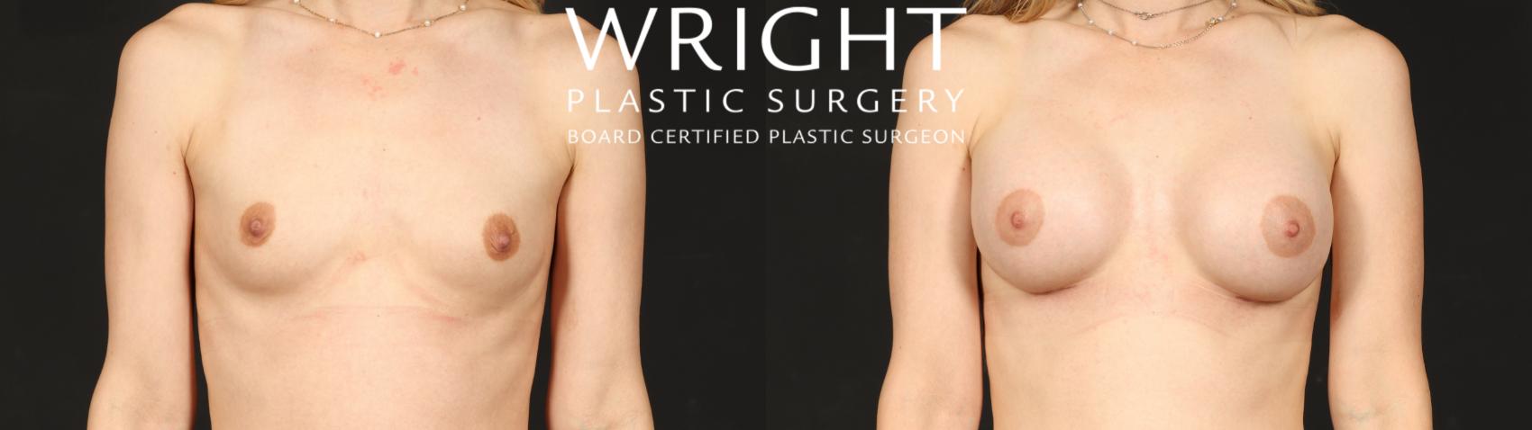 Before & After Breast Augmentation Case 650 Front View in Little Rock, Arkansas