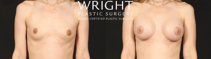 Before & After Breast Augmentation Case 650 Front View in Little Rock, Arkansas