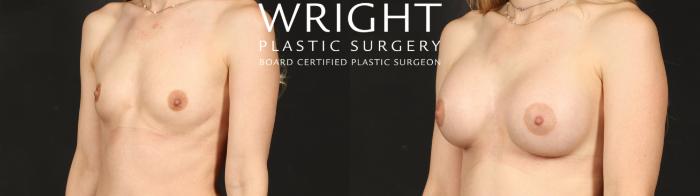 Before & After Breast Augmentation Case 650 Left Oblique View in Little Rock, Arkansas