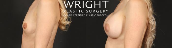 Before & After Breast Augmentation Case 650 Left Side View in Little Rock, Arkansas