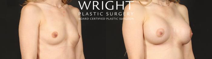 Before & After Breast Augmentation Case 650 Right Oblique View in Little Rock, Arkansas