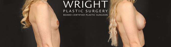 Before & After Breast Augmentation Case 650 Right Side View in Little Rock, Arkansas