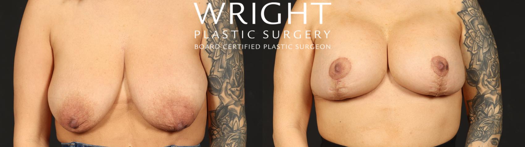 Before & After Breast Augmentation Case 652 Front View in Little Rock, Arkansas
