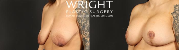 Before & After Breast Augmentation Case 652 Left Oblique View in Little Rock, Arkansas