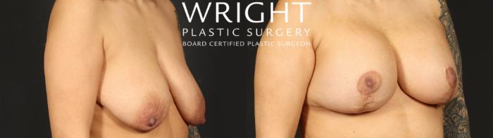 Before & After Breast Augmentation Case 652 Right Oblique View in Little Rock, Arkansas