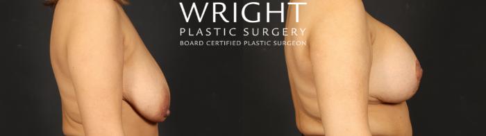 Before & After Breast Augmentation Case 652 Right Side View in Little Rock, Arkansas