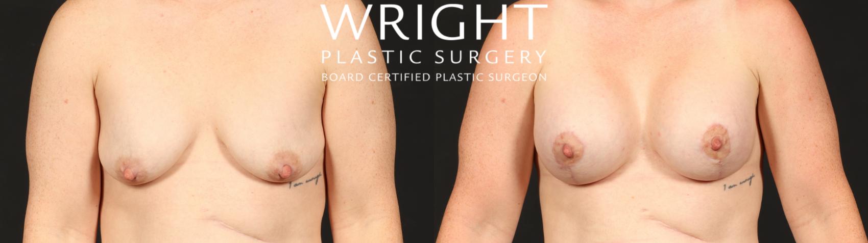 Before & After Breast Augmentation Case 653 Front View in Little Rock, Arkansas