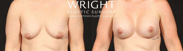 Before & After Breast Augmentation Case 653 Front View in Little Rock, Arkansas