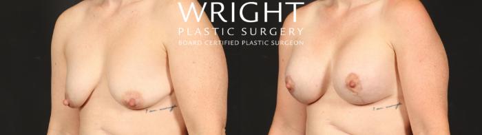 Before & After Breast Augmentation Case 653 Left Oblique View in Little Rock, Arkansas