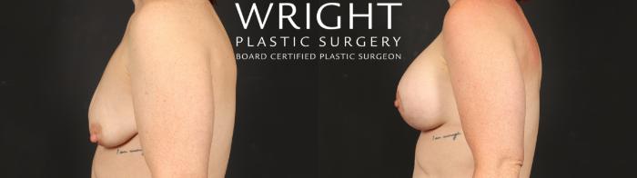 Before & After Breast Augmentation Case 653 Left Side View in Little Rock, Arkansas