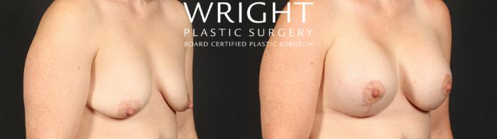 Before & After Breast Augmentation Case 653 Right Oblique View in Little Rock, Arkansas