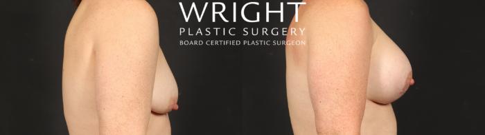 Before & After Breast Augmentation Case 653 Right Side View in Little Rock, Arkansas