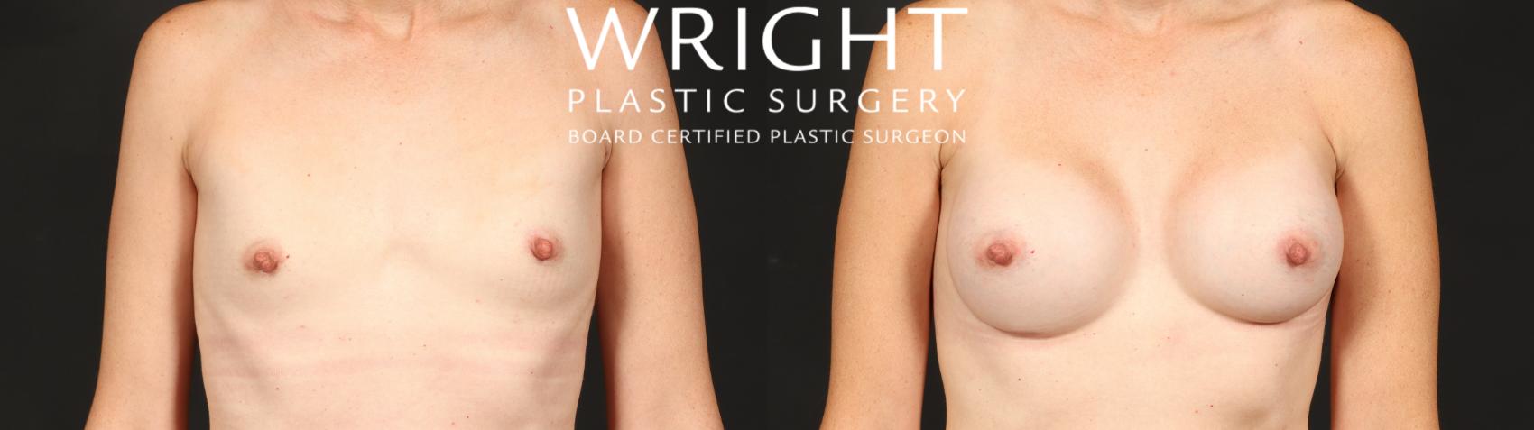 Before & After Breast Augmentation Case 656 Front View in Little Rock, Arkansas