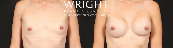 Before & After Breast Augmentation Case 656 Front View in Little Rock, Arkansas