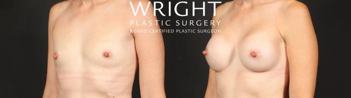 Before & After Breast Augmentation Case 656 Left Oblique View in Little Rock, Arkansas