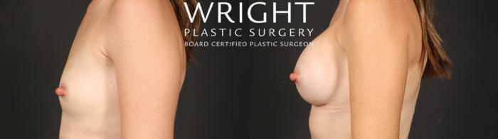 Before & After Breast Augmentation Case 656 Left Side View in Little Rock, Arkansas