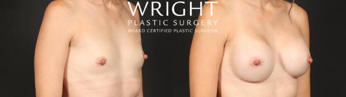 Before & After Breast Augmentation Case 656 Right Oblique View in Little Rock, Arkansas