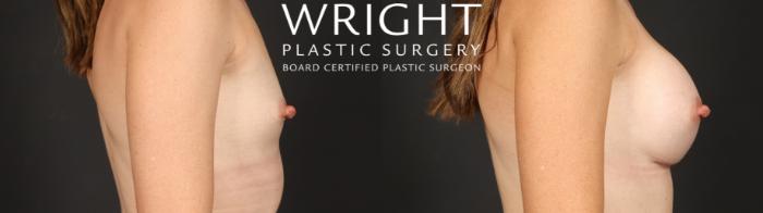 Before & After Breast Augmentation Case 656 Right Side View in Little Rock, Arkansas