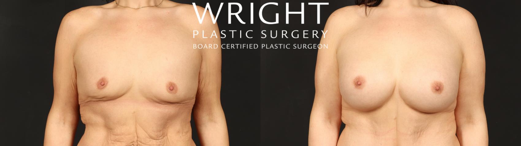 Before & After Breast Augmentation Case 659 Front View in Little Rock, Arkansas