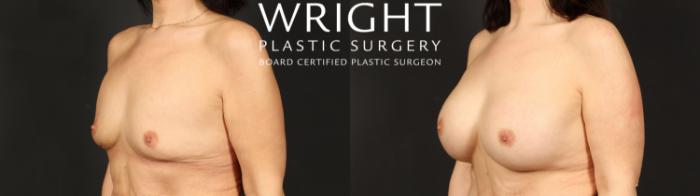 Before & After Breast Augmentation Case 659 Left Oblique View in Little Rock, Arkansas