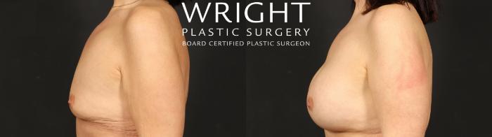 Before & After Breast Augmentation Case 659 Left Side View in Little Rock, Arkansas