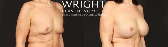 Before & After Breast Augmentation Case 659 Right Oblique View in Little Rock, Arkansas
