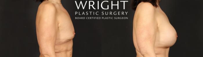 Before & After Breast Augmentation Case 659 Right Side View in Little Rock, Arkansas