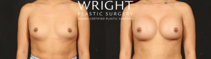 Before & After Breast Augmentation Case 662 Front View in Little Rock, Arkansas