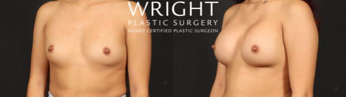 Before & After Breast Augmentation Case 662 Left Oblique View in Little Rock, Arkansas