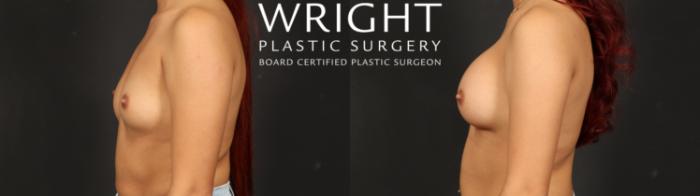 Before & After Breast Augmentation Case 662 Left Side View in Little Rock, Arkansas