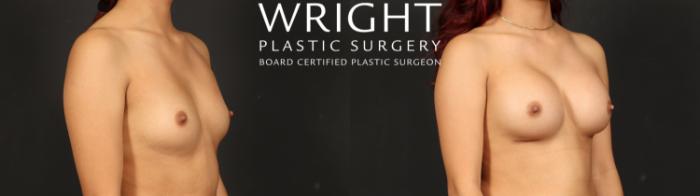 Before & After Breast Augmentation Case 662 Right Oblique View in Little Rock, Arkansas