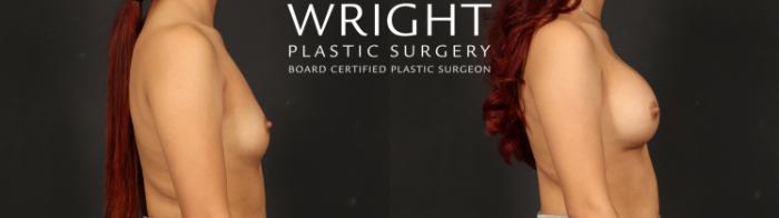 Before & After Breast Augmentation Case 662 Right Side View in Little Rock, Arkansas