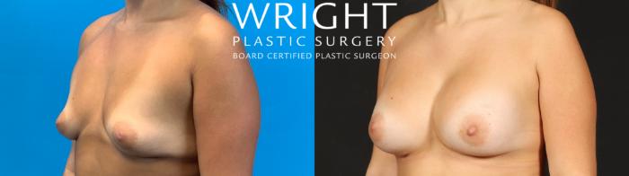 Before & After Breast Augmentation Case 671 Left Oblique View in Little Rock, Arkansas