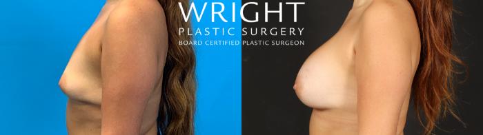 Before & After Breast Augmentation Case 671 Left Side View in Little Rock, Arkansas