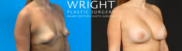 Before & After Breast Augmentation Case 671 Right Oblique View in Little Rock, Arkansas