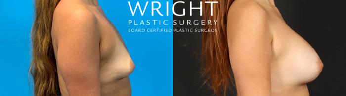 Before & After Breast Augmentation Case 671 Right Side View in Little Rock, Arkansas