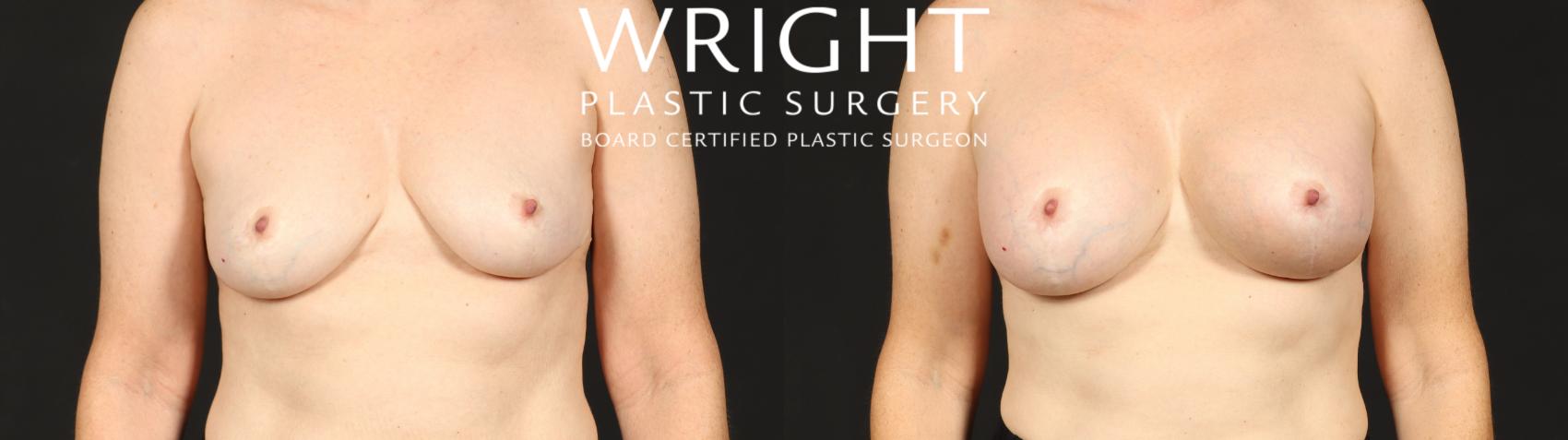 Before & After Breast Augmentation Case 681 Front View in Little Rock, Arkansas