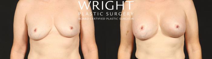 Before & After Breast Augmentation Case 681 Front View in Little Rock, Arkansas