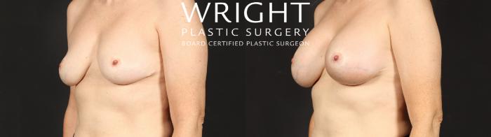 Before & After Breast Augmentation Case 681 Left Oblique View in Little Rock, Arkansas