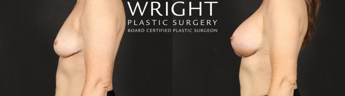 Before & After Breast Augmentation Case 681 Left Side View in Little Rock, Arkansas