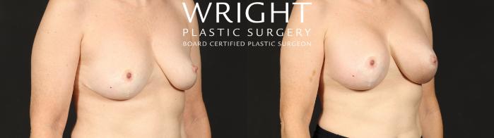 Before & After Breast Augmentation Case 681 Right Oblique View in Little Rock, Arkansas